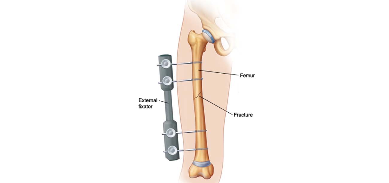 Fracture Fixation