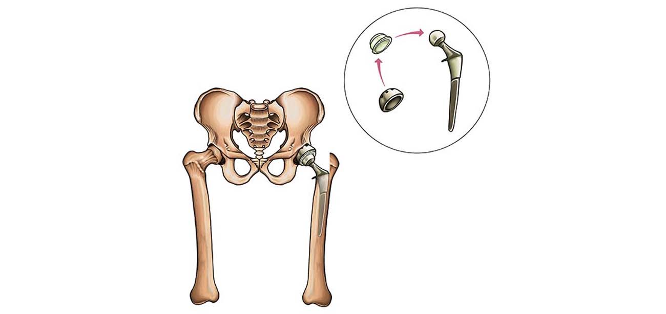 Total Hip Replacement (THR)